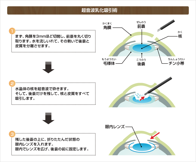 超音波乳化吸引術