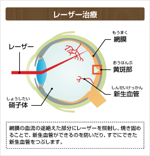 レーザー治療