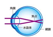 装着前：近視の状態