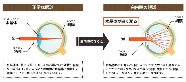 白内障の原因