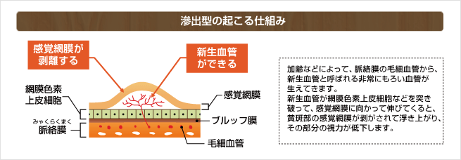 滲出型の起こる仕組み